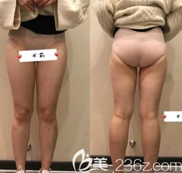 水動(dòng)力吸脂手術(shù)前照片