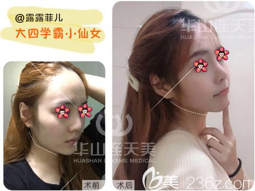 杭州連天美高俊明院長下頜角案例 杭州連天美高俊明院長下頜角案例