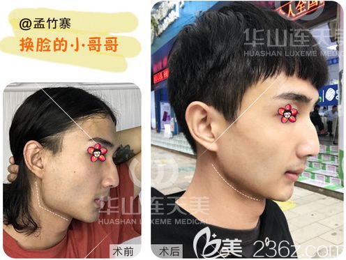 杭州連天美陳小平下頜角改臉型案例 杭州連天美陳小平下頜角改臉型案例