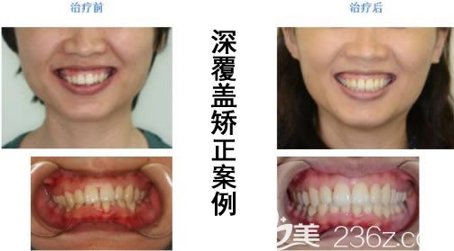 成都圣貝賈永慶成人深覆蓋矯正后臉型變化對(duì)比照 成都圣貝賈永慶成人深覆蓋矯正后臉型變化對(duì)比照