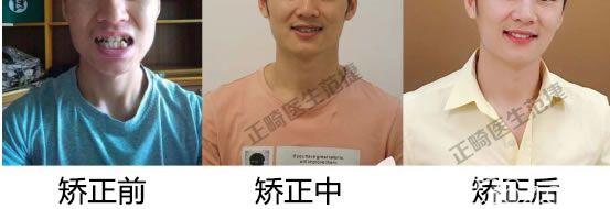 矯正過程中的變化圖