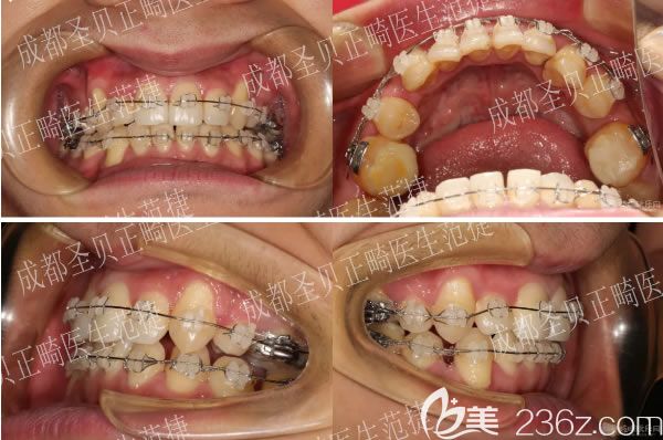 摘掉牙套后的矯正效果