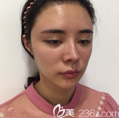 廣州天姿脂肪填充術(shù)前照片 廣州天姿脂肪填充術(shù)前照片