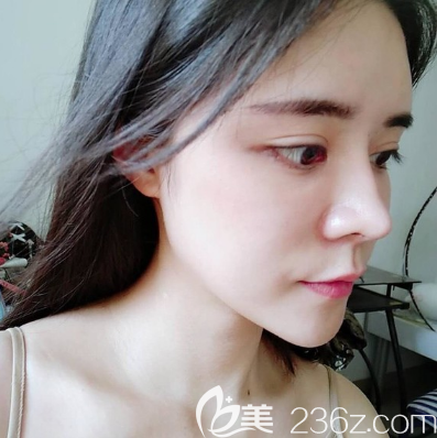 我去廣州天姿整形醫(yī)院找周祺院長做了全臉自體脂肪填充,因?yàn)槊娌堪枷葑屛铱雌饋砗茱@老