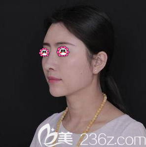 在北京沃爾整形做鼻修復一個多月<span style=