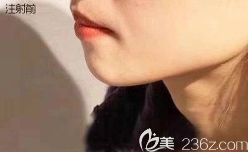 我在湘潭雅美整形豐下巴前的照片 我在湘潭雅美整形豐下巴前的照片