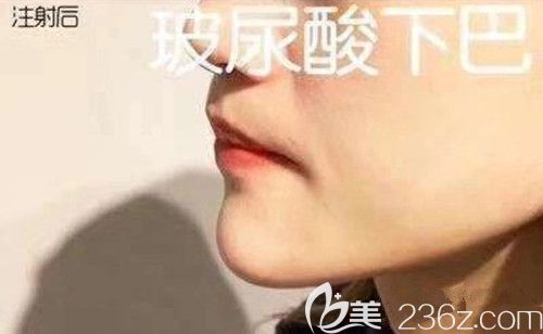 湘潭雅美整形醫(yī)院玻尿酸豐下巴天 湘潭雅美整形醫(yī)院玻尿酸豐下巴天