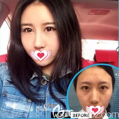 元辰SVF自體脂肪全面部填充真人前后效果對比