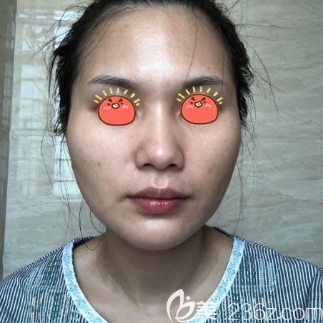 杭州連天美做下頜角手術(shù)前 杭州連天美做下頜角手術(shù)前