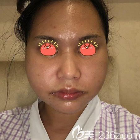 杭州醫(yī)院剛做完下頜角照片 杭州醫(yī)院剛做完下頜角照片