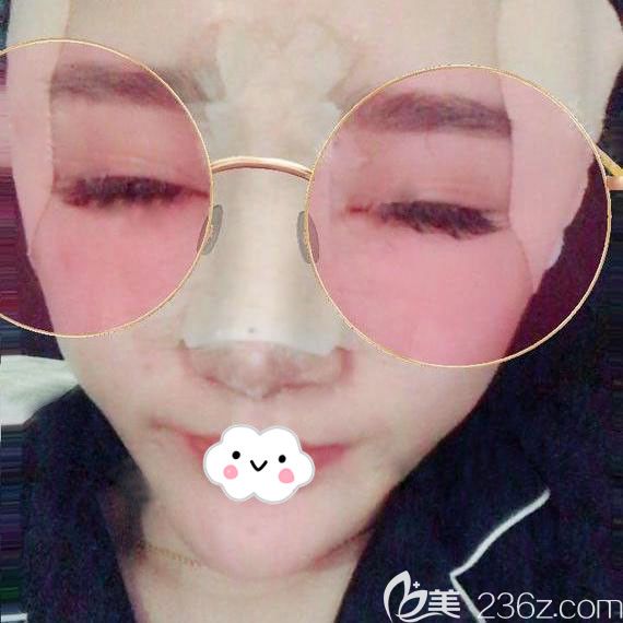 武漢藝星自體脂肪豐面案例效果圖