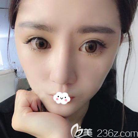 武漢自體脂肪面部填充哪家醫(yī)院好，武漢藝星案例術(shù)后效果圖