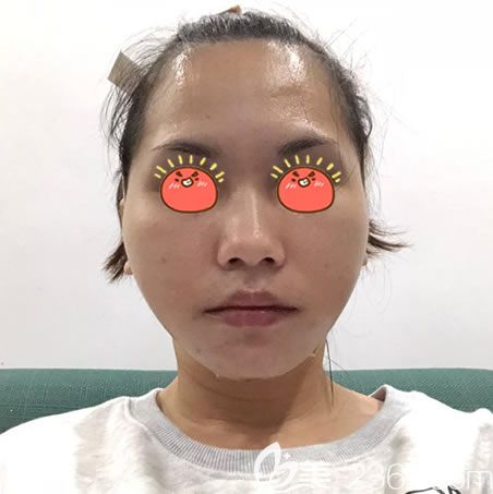 杭州連天美高俊明下頜角案例 杭州連天美高俊明下頜角案例