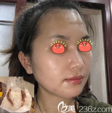 杭州連天美下頜角案例40天效果 杭州連天美下頜角案例40天效果