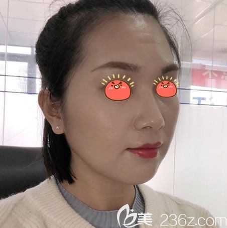 杭州連天美整形下頜角案例 杭州連天美整形下頜角案例