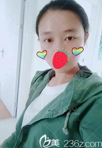 譚亮分享做完雙眼皮+去皮去脂術(shù)后半個(gè)月恢復(fù)