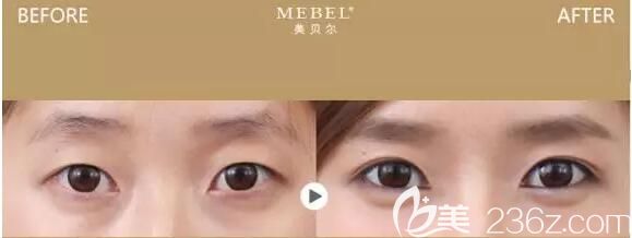 梁志偉醫(yī)生雙眼皮對比案例 梁志偉醫(yī)生雙眼皮對比案例