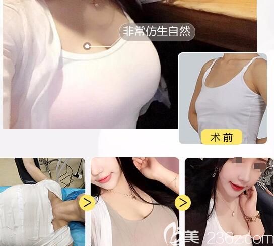 聶志宏醫(yī)生隆胸前后對(duì)比照 聶志宏醫(yī)生隆胸前后對(duì)比照