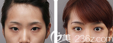 刁金蘭雙眼皮案例