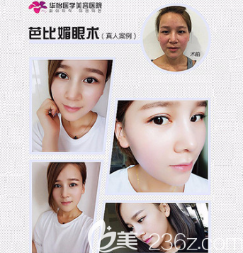 張?zhí)O醫(yī)生雙眼皮案例