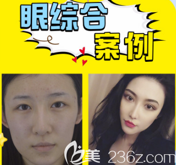 王玉珍醫(yī)生雙眼皮案例