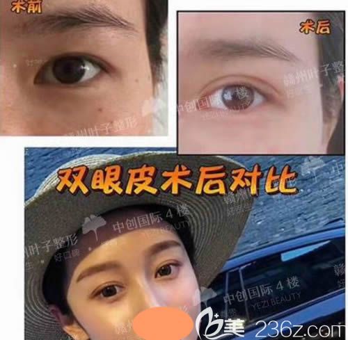 贛州葉子整形醫(yī)院全切雙眼皮前后對比照片 贛州葉子整形醫(yī)院全切雙眼皮前后對比照片