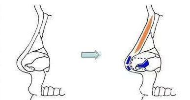 <!--<i data=20240703-sp></i>-->美萊醫(yī)療美容醫(yī)院<!--<i data=20240703-sp></i>-->隆鼻知識(shí)