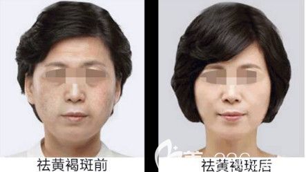 攸海濤醫(yī)生祛除黃褐斑案例