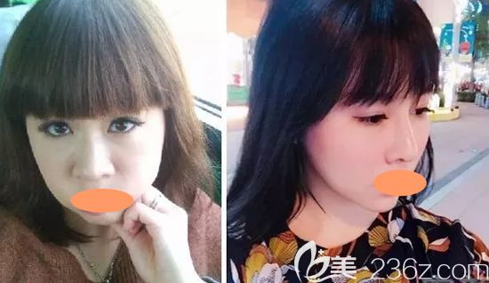 景德鎮(zhèn)圣嘉麗整形好不好?劉志強雙眼皮祛斑等案例效果及價格表分享給大家看