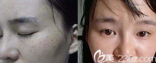 景德鎮(zhèn)圣嘉麗激光祛斑真人案例效果前后對(duì)比圖 