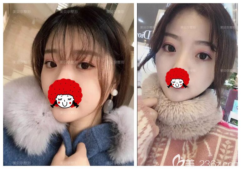 蘇州美貝爾聶志宏院長擅長什么項(xiàng)目?90后淘寶模特為什么找他做埋線雙眼皮+上瞼下垂矯正改變那么大