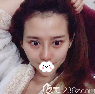 自體脂肪面部填充術(shù)前照片 自體脂肪面部填充術(shù)前照片