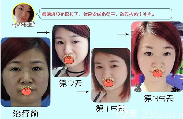 瑞安瑞麗醫(yī)院任震祛黃褐斑案例 瑞安瑞麗醫(yī)院任震祛黃褐斑案例