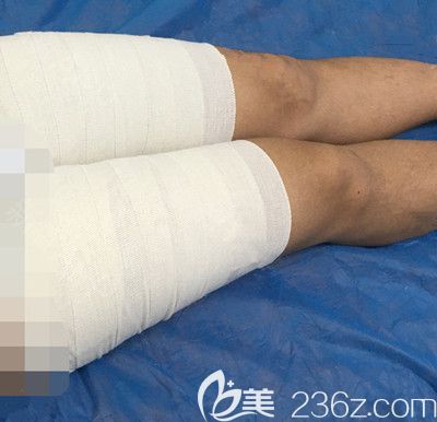 大腿吸脂第3天對(duì)比圖