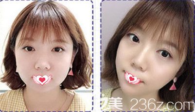 石家莊天宏整形醫(yī)院注射豐下巴案例