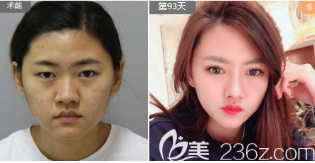 楊輝醫(yī)生假體隆鼻案例