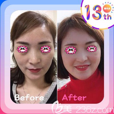 衡陽(yáng)雅美廖偉龍自體脂肪面部填充變化圖