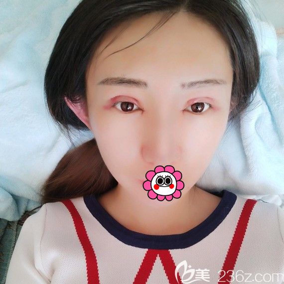 黑龍江瑞麗雙眼皮術(shù)后3天眼睛紅腫 黑龍江瑞麗雙眼皮術(shù)后3天眼睛紅腫