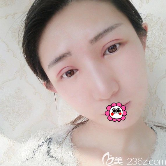 黑龍江瑞麗雙眼皮術(shù)后7天拆完線后 黑龍江瑞麗雙眼皮術(shù)后7天拆完線后