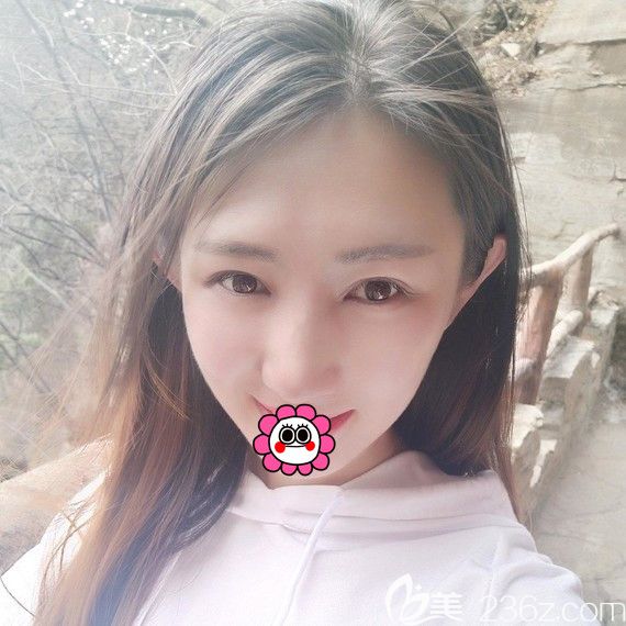 終于鼓足勇氣到黑龍江瑞麗做了切開雙眼皮+開內(nèi)眼角手術(shù)