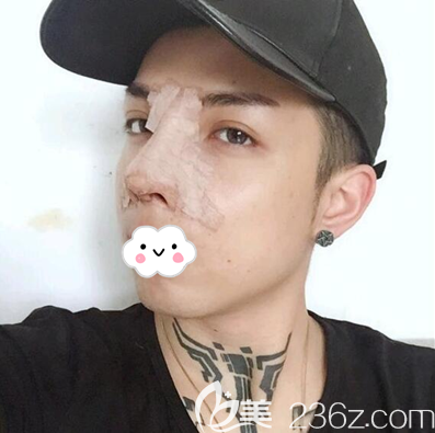 顏?zhàn)釉评哕浌锹”切g(shù)后即刻 顏?zhàn)釉评哕浌锹”切g(shù)后即刻