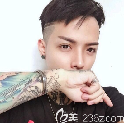 自體肋軟骨隆鼻術(shù)后一個(gè)月恢復(fù)效果 自體肋軟骨隆鼻術(shù)后一個(gè)月恢復(fù)效果