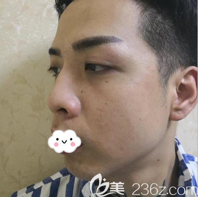 說術(shù)前鼻子側(cè)面有些駝峰鼻 說術(shù)前鼻子側(cè)面有些駝峰鼻