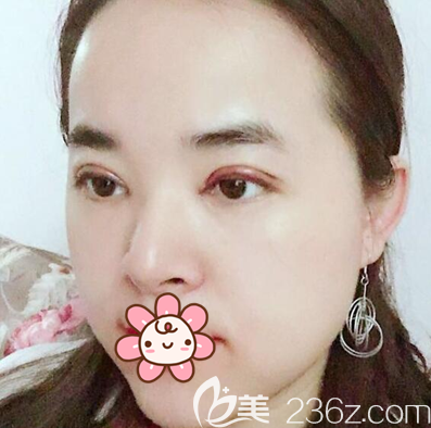 全切雙眼皮術(shù)后4天恢復圖 全切雙眼皮術(shù)后4天恢復圖