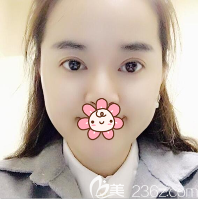 車紅昌切開雙眼皮開眼角術(shù)后2個月恢復照 車紅昌切開雙眼皮開眼角術(shù)后2個月恢復照