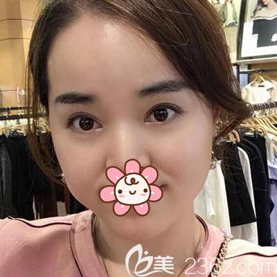 成都西區(qū)醫(yī)院車紅昌雙眼皮開眼角術(shù)后3個月 成都西區(qū)醫(yī)院車紅昌雙眼皮開眼角術(shù)后3個月