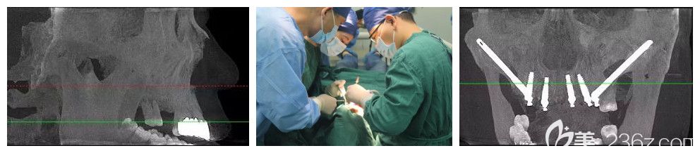 杭州美奧口腔王明穿顴種植手術案例 杭州美奧口腔王明穿顴種植手術案例