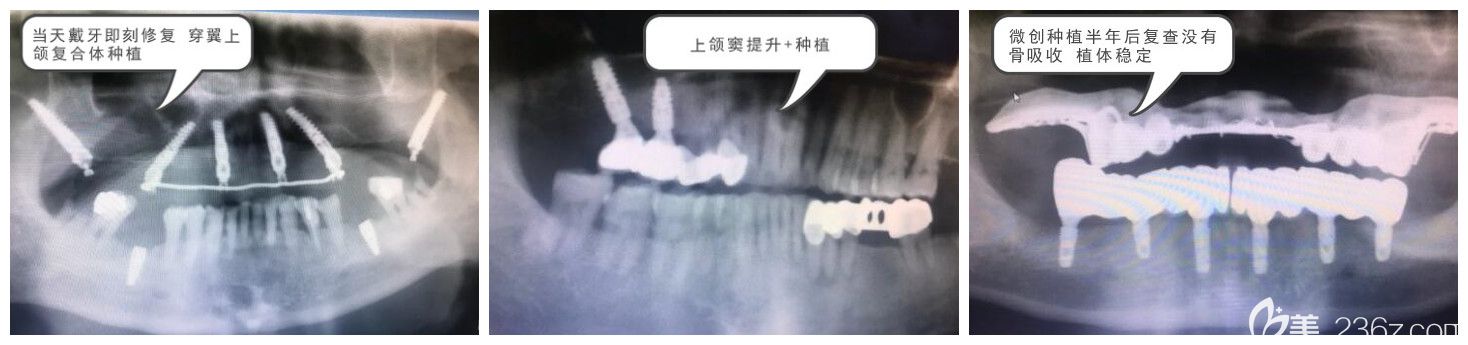 美奧口腔王明院長種植牙案例 美奧口腔王明院長種植牙案例