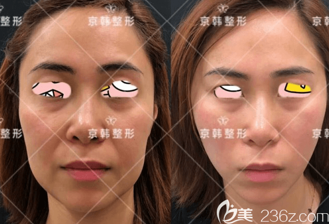 北京京韓郭尚琴醫(yī)生面部埋線提升案例