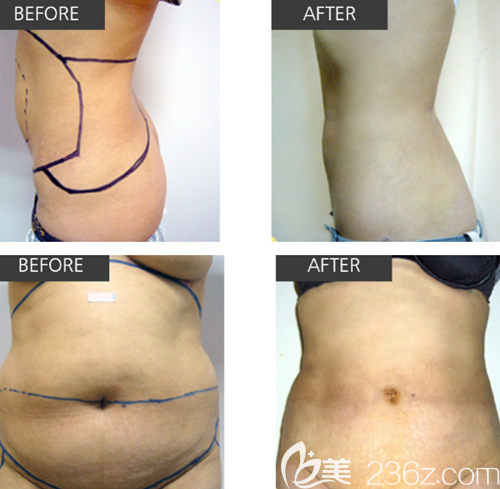 韓國(guó)CDU清潭優(yōu)吸脂手術(shù)案例 韓國(guó)CDU清潭優(yōu)吸脂手術(shù)案例